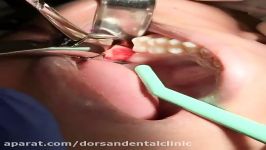 جراحی دندان عقل در کلینیک دندانپزشکی غرب تهران درسان