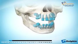 رویش دندان های شیری اصلی  دکتر سعید قریشی