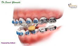 شکستن براکت ها در ارتودنسی  دکتر سعید قریشی