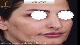 فیلم جراحی بینی دکتر نجف بیگی