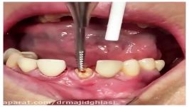 کشیدن دندان دکترمجیدقیاسی بهترین دندانپزشک زیبایی