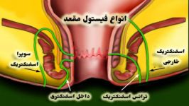 فیلم جراحی فیستول مقعدی