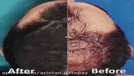 موفق ترین درمان ریزش رویش مجدد مو