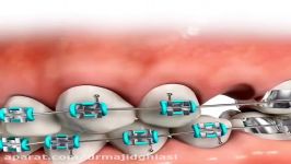 مراحل ارتودنسی دندان دکترمجیدقیاسی بهترین دندانپزشک زیبایی