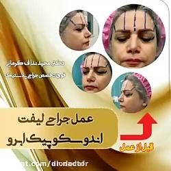 الو دکتر عمل جراحی لیفت آندوسکوپیک ابرو