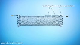 استنت مری برای خونریزهای واریسال ELLA CS Danis Stent