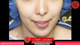 تزریق چربی  فیلم تزریق چربی  کلینیک پوست مو رز  شماره31