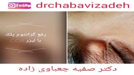 رفع گزانتوم پلک لیزر co2  دکتر صفیه چعباوی زاده