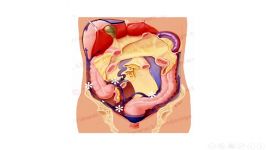 پانل Indications out e of CRS+HIPEC for carcinomatosis