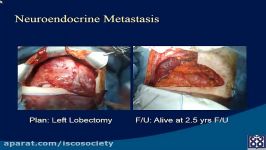 Liver metastectomy in non colorectal cancer