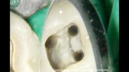 Access Preparations Mandibular Molars