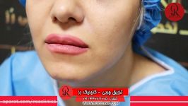 تزریق چربی  فیلم تزریق چربی  کلینیک پوست مو رز  شماره33