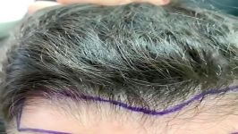 افضل مركز لزراعة الشعر فی ایران  دكتور تجمیل