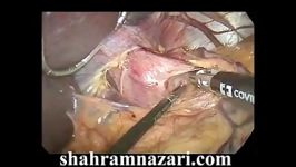 عمل جراحی لاپاروسکوپی آشالازی توسط دکتر شهرام نظری