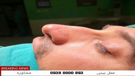 عمل جراحی بینی استخوانی رفع قوز افتادگی بینی توسط دکتر حسین حامدی در مشهد 09