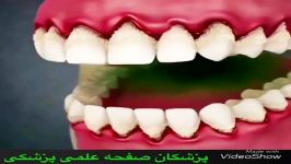 عوارض مسواک نزدن...بلایی تجمع پلاگها به سر دندون لثه میارن