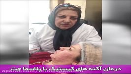 پلاسماجت برای درمان آکنه  دکتر مولازاده