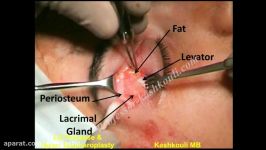 فیکس غده اشکی در جراحی بلفاروپلاستی پف پلک