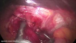 lap gastric banding