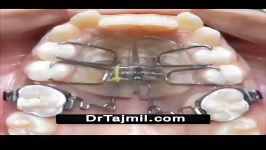 زراعة الاسنان فی ایران  علاج الاسنان فی ایران  دكتور تجمیل