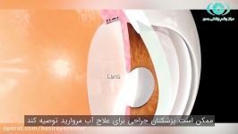 آیا درمانی برای آب مروارید وجود دارد؟