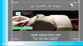 کاشت مو  فیلم کاشت مو  کلینیک پوست مو مارال  شماره 5