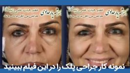 بلافاصله بعد جراحی زیبایی پلک