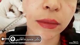 مزوتراپی صورت دکتر حمیده آقایی