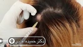درمان ریزش موی سکه ای مزوتراپی