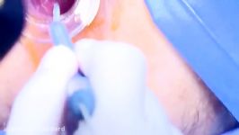 فیلم واقعی عمل جراحی بواسیر لیزر  درمان بواسیر لیزر دکتر درد