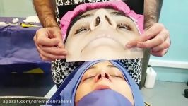 جراحی انحراف بینی توسط دکتر امید ابراهیمی بهترین جراح بینی