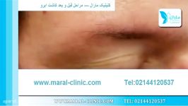 کاشت ابرو  فیلم کاشت ابرو  کلینیک پوست مو مارال  شماره 8