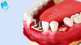 زراعة الاسنان في ايران  علاج الاسنان في ايران  دكتور تجميل