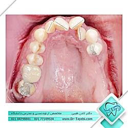 اصلاح بینظمی دندانی  دکتر لادن طیبی