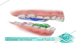 دستگاه فانکشنال ارتودنسی  دکتر لادن طیبی
