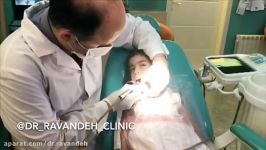 دکتر نوید رونده، ترمیم دندان آسیای دوم بیمار سه ساله