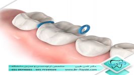 سپریتور جداکننده دندان  دکتر لادن طیبی