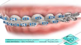 عدم رعایت نکات غذایی در ارتودنسی  دکتر طیبی