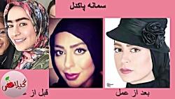 چهره بازیگران زن ایرانی قبل بعد عمل زیبایی