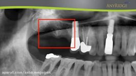 Clinical case AnyRidge implant