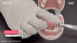 هندزآن بی دندانی تک واحدی روش ایمپلنت دیجیتال DIOnavi