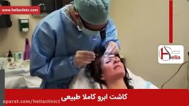 کاشت ابرو  فیلم کاشت ابرو  کلینیک پوست مو هلیا  شماره 4