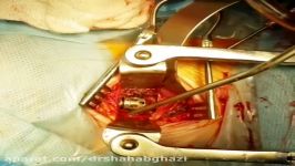 کلیپ پزشکی جراحی مهره گردن،دکتر میرسعید،پزشک جراح مغز،اعصاب،ستون فقرات 26712439
