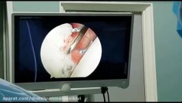 جراحی دررفتگی مکرر مفصل شانه ضایعه لابروم به روش آرتروسکپی