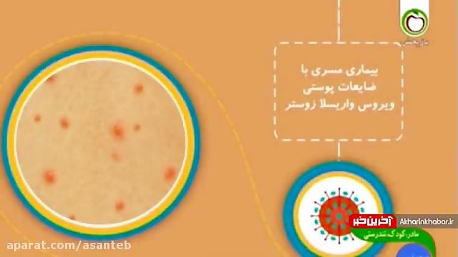 همه چیز در مورد بیماری آبله مرغان