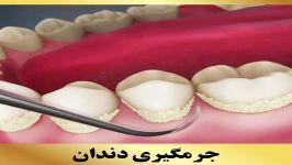 جرمگیری دندان  کلینیک دندانپزشکی سیمادنت