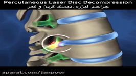کلیپ پزشکی جراحی دیسک گردن کمر لیزر،جراحی لیزری،متخصص جراحی دیسک۲۶۷۱۲۴۳۹