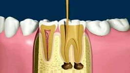 طریقه پرکردن عصب کشی دندان 