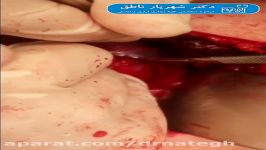 جراحی توده کلیه حفظ باقیمانده کلیه پارشیال نفرکتومی