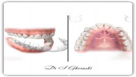 ارتودنسی نامرئی  دکتر سعید قریشی